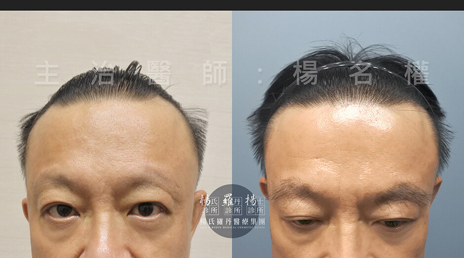 ARTAS 禿頭 植髮 生髮 掉髮